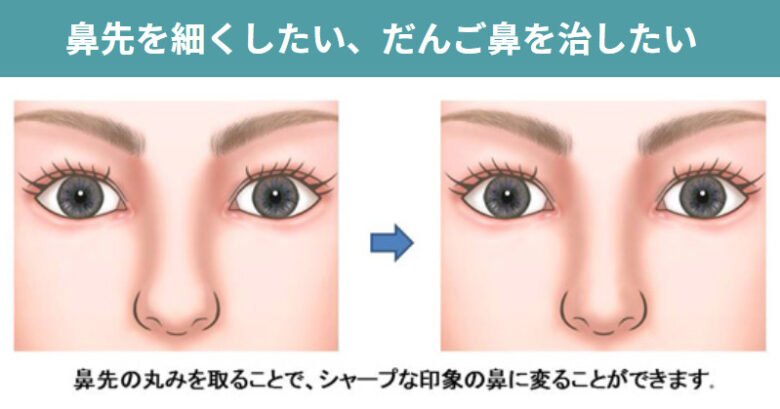 小鼻へ整形